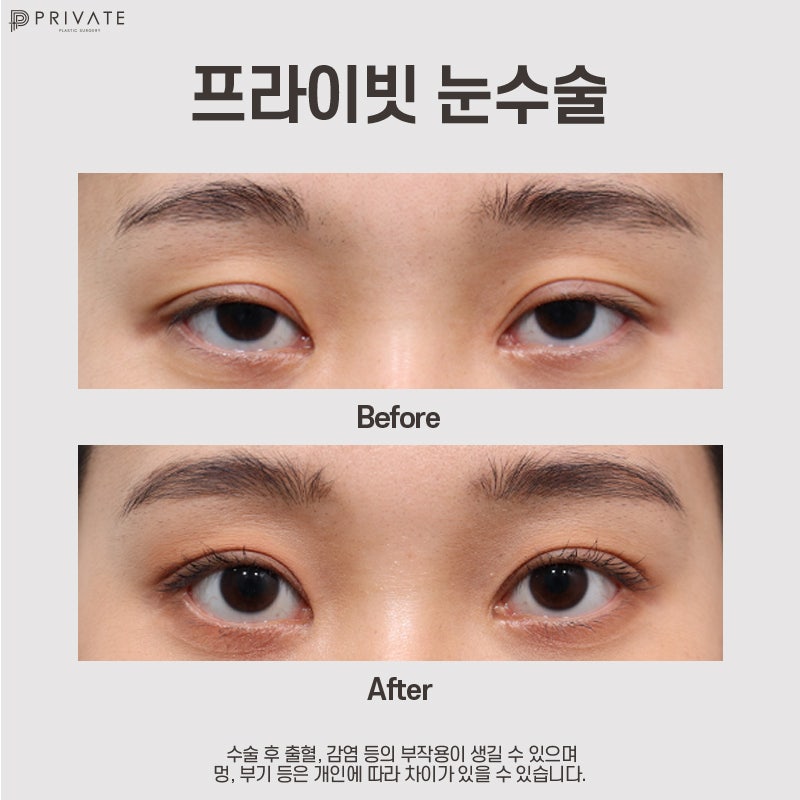 프라이빗성형외과 눈매교정수술후기 비교가 딱이야 사진 9