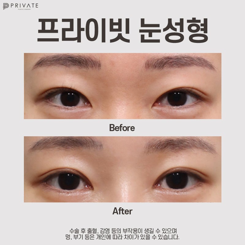 สถานที่ทำตาสองชั้นแบบธรรมชาติที่ดีที่สุดคือ Private Plastic Surgery 사진 9