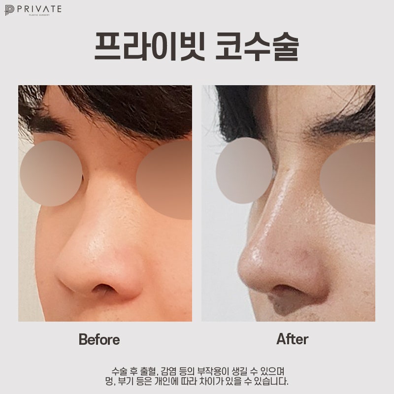 프라이빗성형외과 자가늑연골코성형수술 알아보기 사진 10