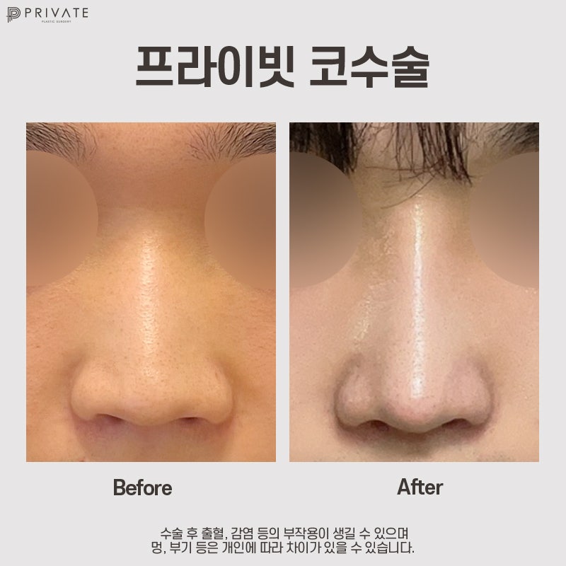 프라이빗성형외과 자가늑연골코성형수술 알아보기 사진 8