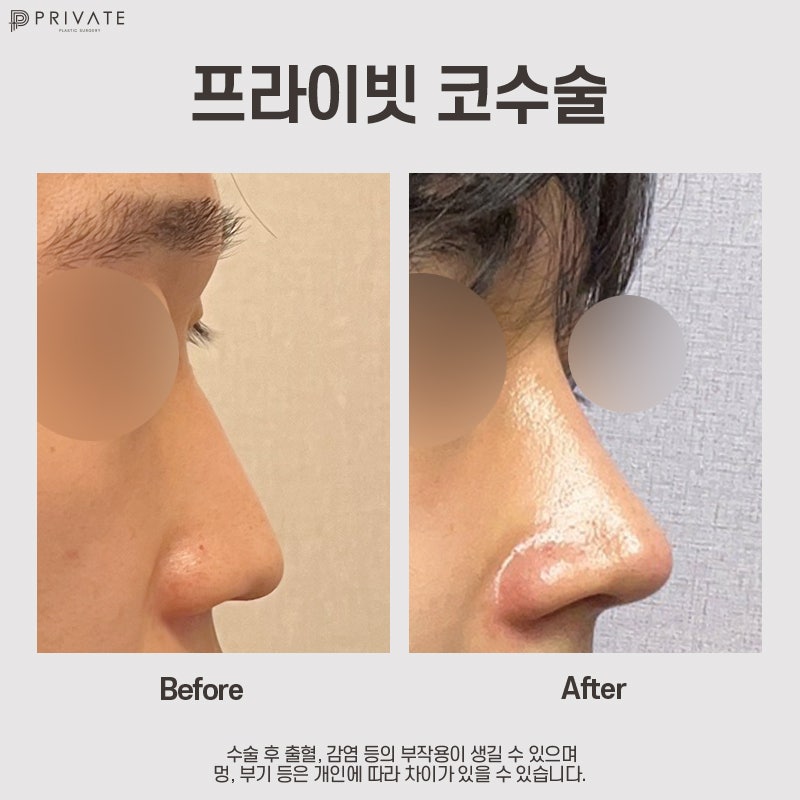 프라이빗성형외과 자가늑연골코성형수술 알아보기 사진 9