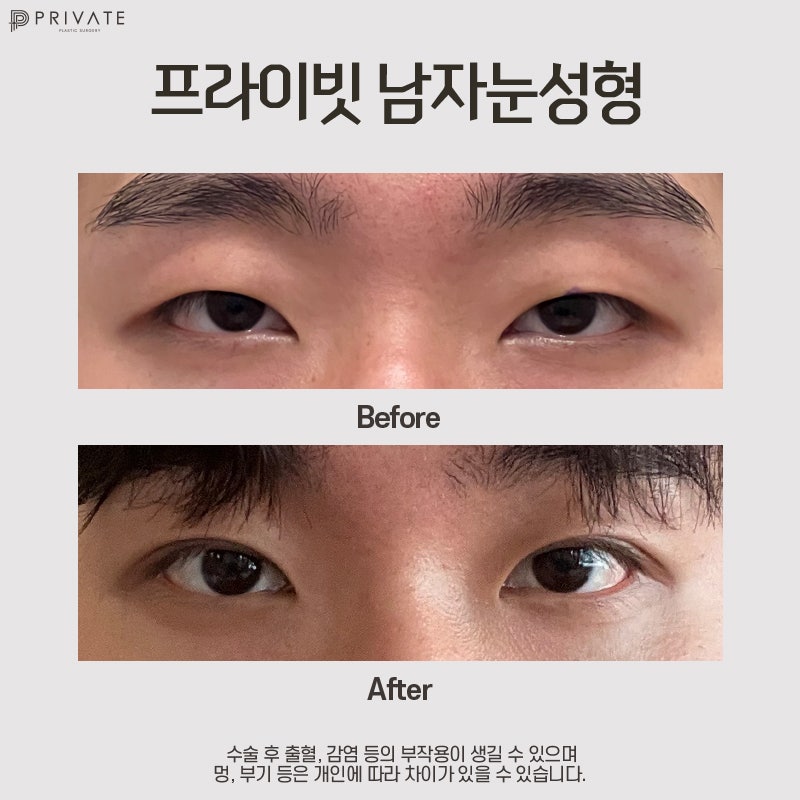 Private Plastic Surgery Clinic: Male Eye Surgery 사진 8