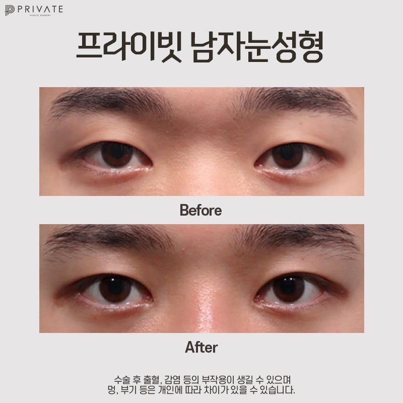 Private Plastic Surgery Clinic: Male Eye Surgery 사진 7