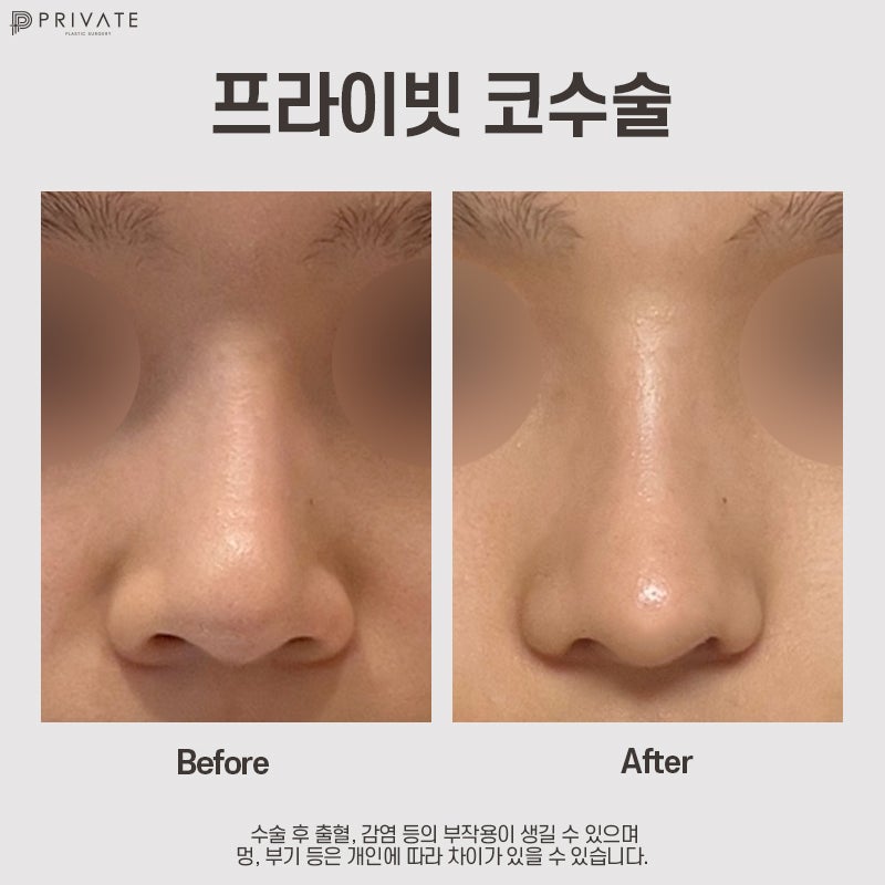 Sinsa Station Plastic Surgery: Best Place for Alar Reduction 사진 9