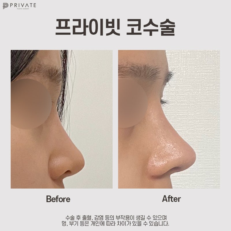 Sinsa Station Plastic Surgery: Best Place for Alar Reduction 사진 10