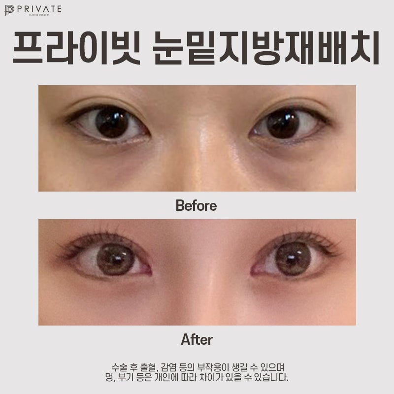 Lower Eyelid Fat Repositioning Surgery at Private Plastic Surgery Clinic 사진 7