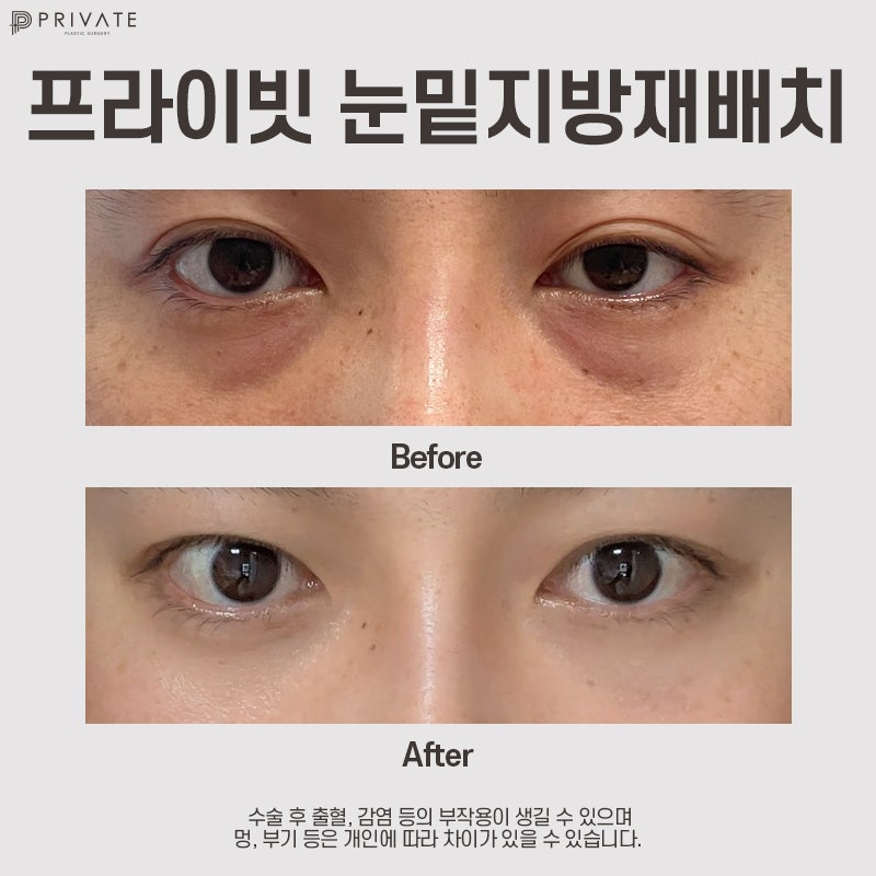 Lower Eyelid Fat Repositioning Surgery at Private Plastic Surgery Clinic 사진 8
