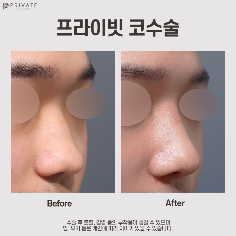 Private Plastic Surgery Clinic: Male Nose Tip Surgery 사진 10