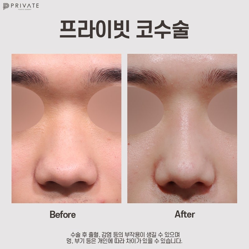 Private Plastic Surgery Clinic: Male Nose Tip Surgery 사진 9