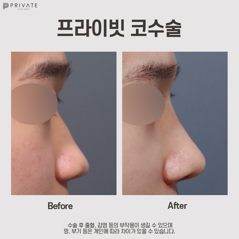 Private Plastic Surgery Clinic: Male Nose Tip Surgery 사진 8