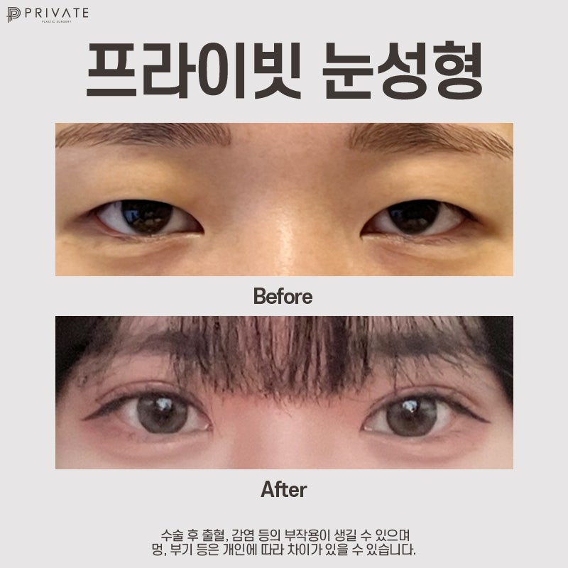 Highly Satisfying Ptosis Correction Double Eyelid Surgery at Private Plastic Surgery Clinic 사진 7