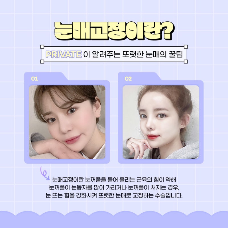 Highly Satisfying Ptosis Correction Double Eyelid Surgery at Private Plastic Surgery Clinic