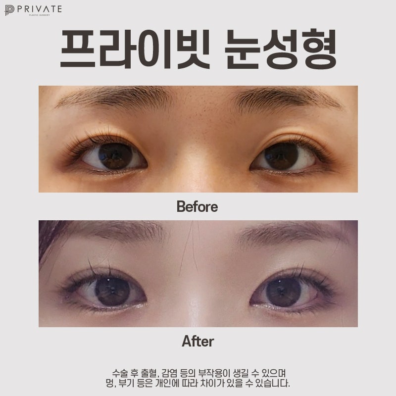 Highly Satisfying Ptosis Correction Double Eyelid Surgery at Private Plastic Surgery Clinic 사진 8