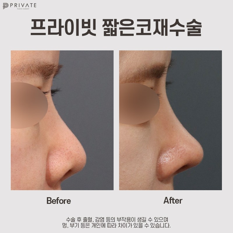 Private Plastic Surgery Clinic: Short Nose Revision Surgery 사진 12