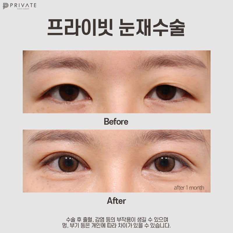 Sinsa Eye Revision Surgery: Discover Private Plastic Surgery Clinic 사진 8