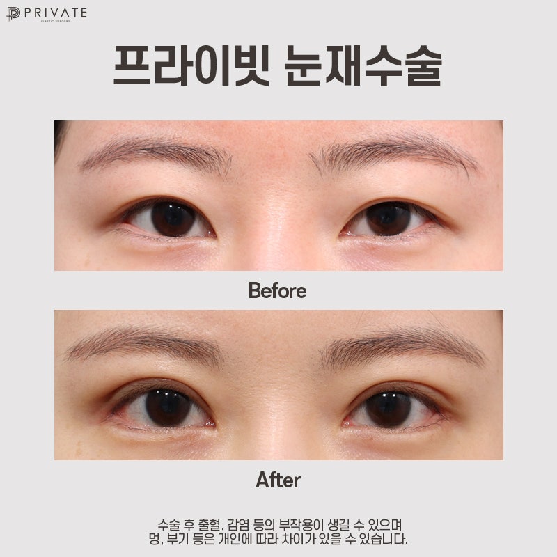 Sinsa Eye Revision Surgery: Discover Private Plastic Surgery Clinic 사진 9