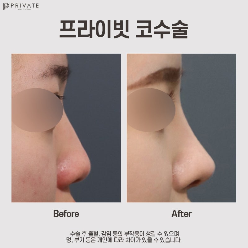 Private Plastic Surgery Clinic with Excellent Nose Tip Surgery Reviews 사진 9