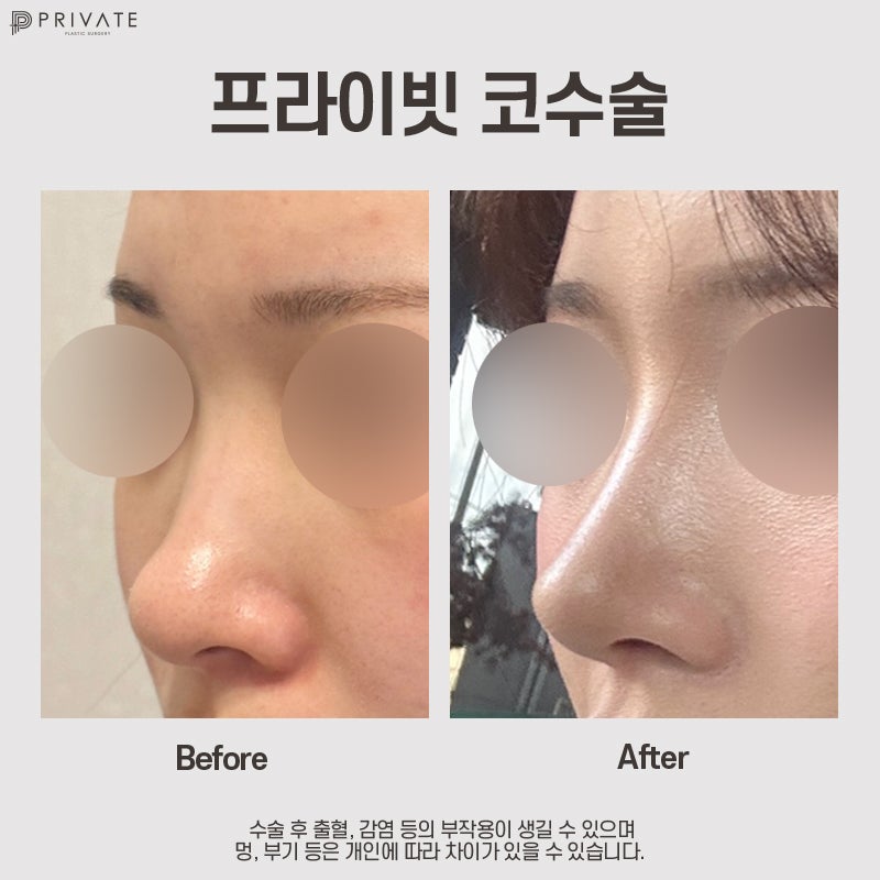 Operasi Plastik Hidung Pendek di Private Plastic Surgery 사진 9