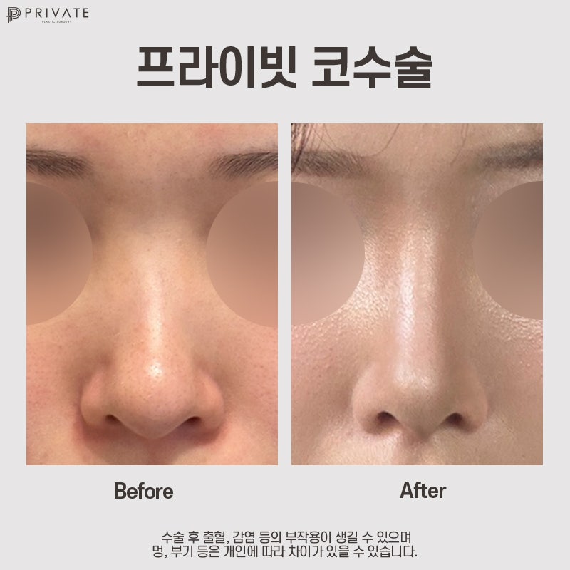 Operasi Plastik Hidung Pendek di Private Plastic Surgery 사진 10