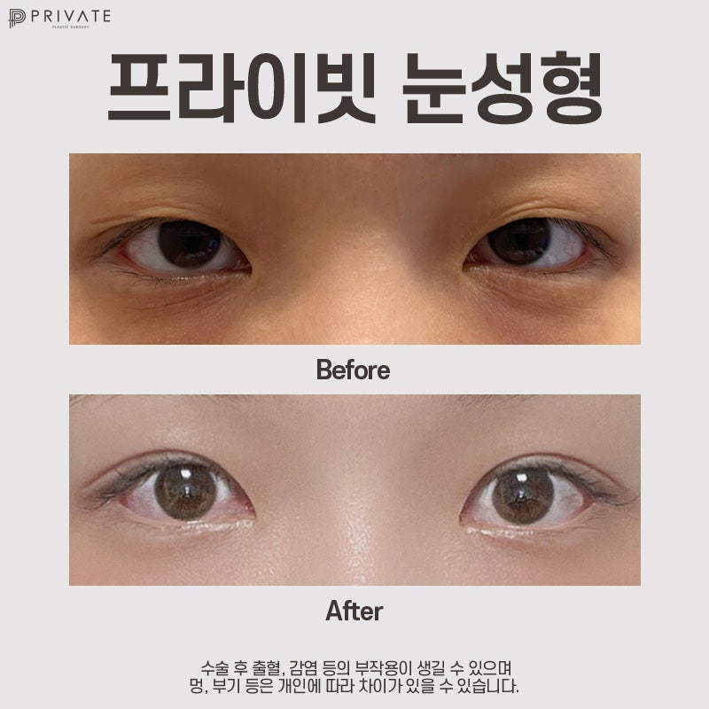 Double Eyelid Revision Surgery at Private Plastic Surgery Clinic 사진 9
