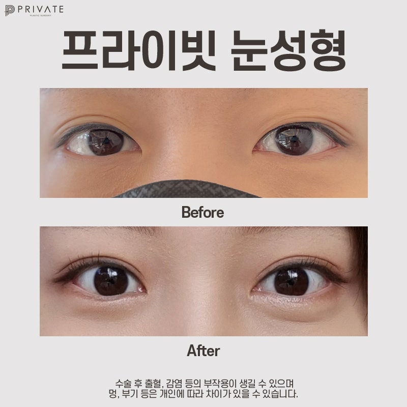 Double Eyelid Revision Surgery at Private Plastic Surgery Clinic 사진 10