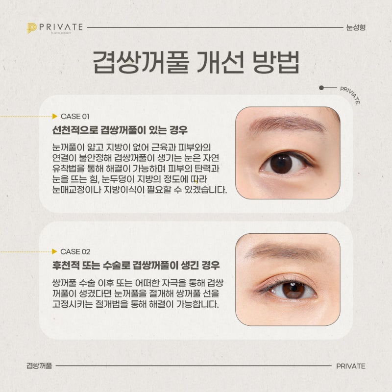 Double Eyelid Revision Surgery at Private Plastic Surgery Clinic 사진 4