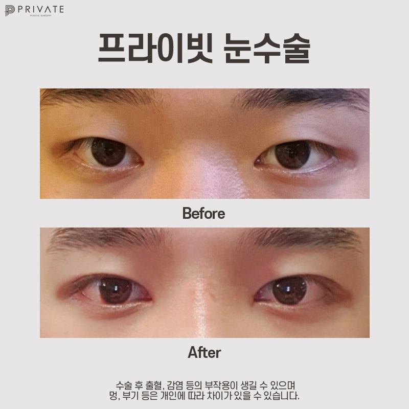Male Eye Surgery at Private Plastic Surgery Clinic 사진 8