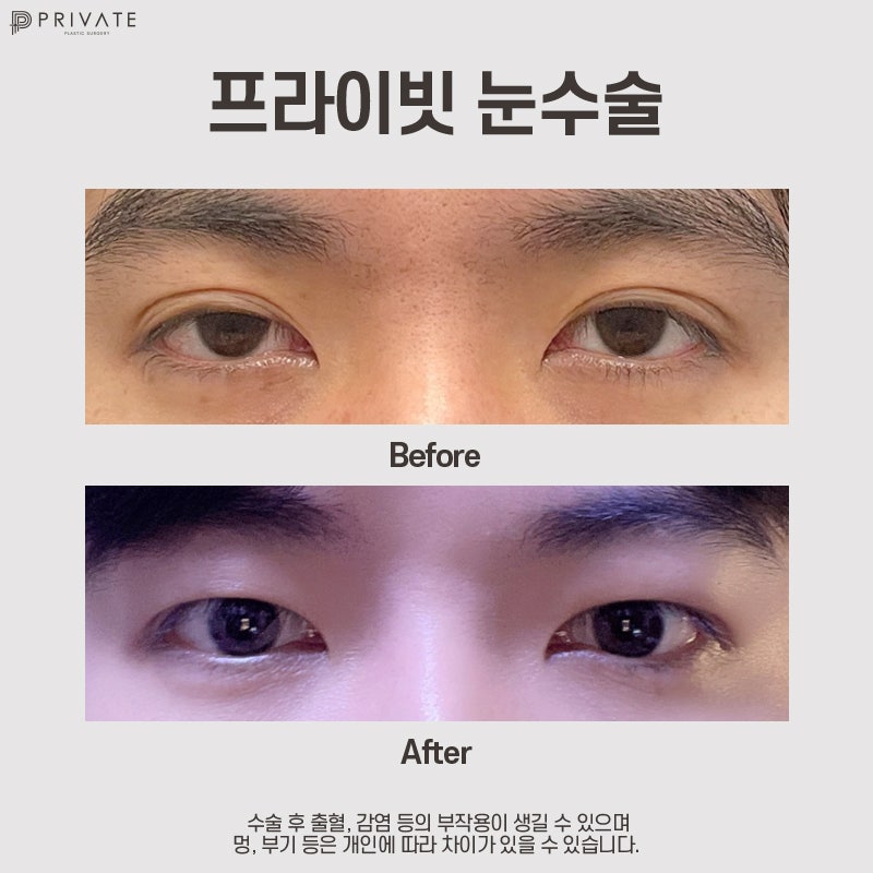 Male Eye Surgery at Private Plastic Surgery Clinic 사진 7