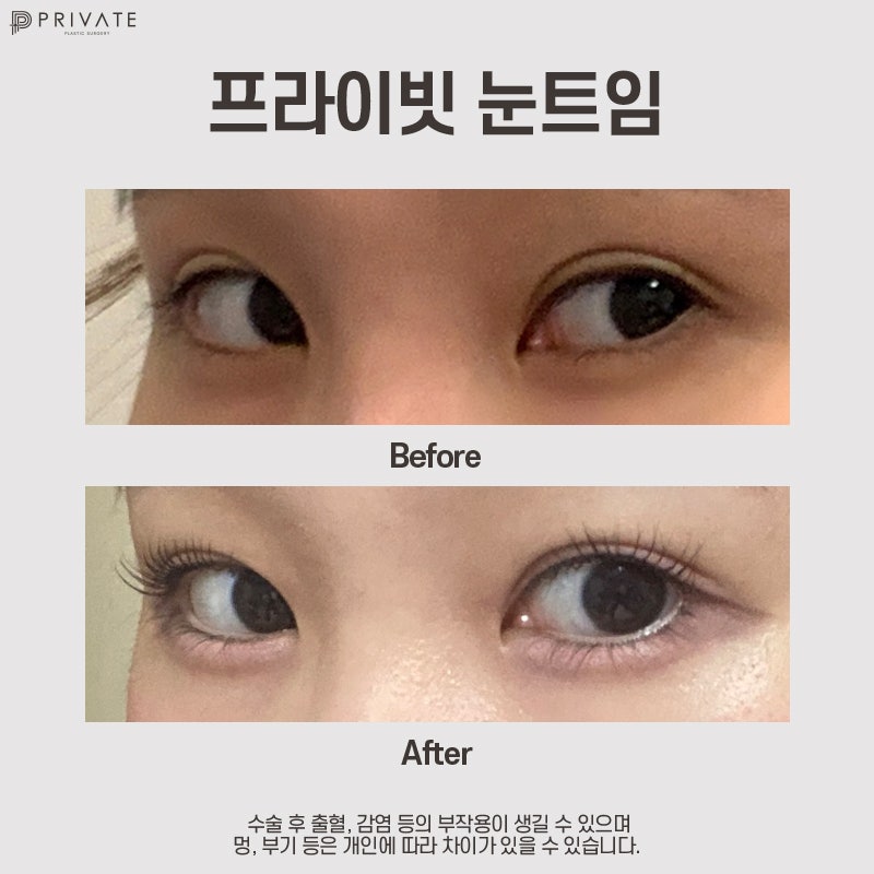 Full Epicanthoplasty at Private Plastic Surgery Clinic 사진 9