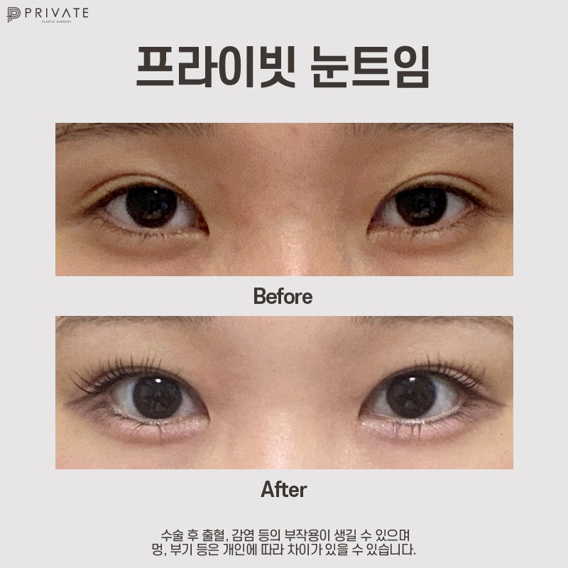 Full Epicanthoplasty at Private Plastic Surgery Clinic 사진 8