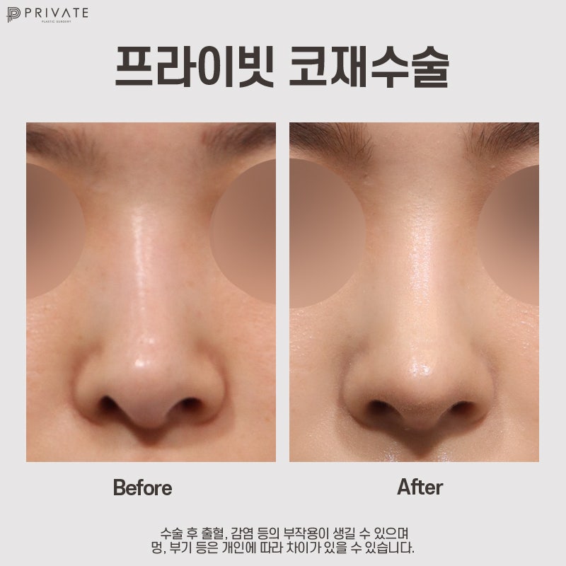 Nose Revision Surgery: Private Plastic Surgery Clinic Recommendation 사진 9