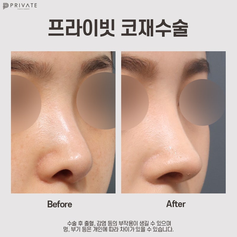 Nose Revision Surgery: Private Plastic Surgery Clinic Recommendation 사진 10