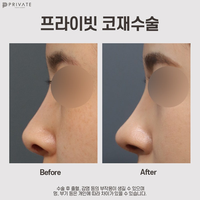 Nose Revision Surgery: Private Plastic Surgery Clinic Recommendation 사진 11