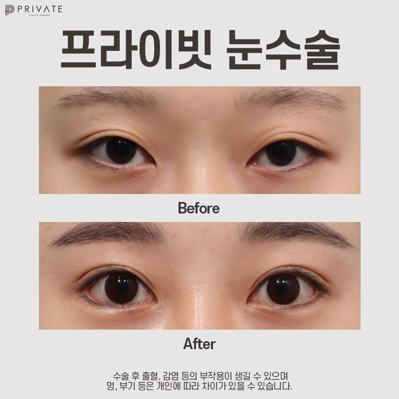 Sinsa Station Eye Plastic Surgery is Private Plastic Surgery 사진 8