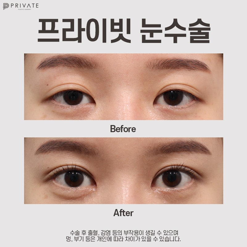 Sinsa Station Eye Plastic Surgery is Private Plastic Surgery 사진 9