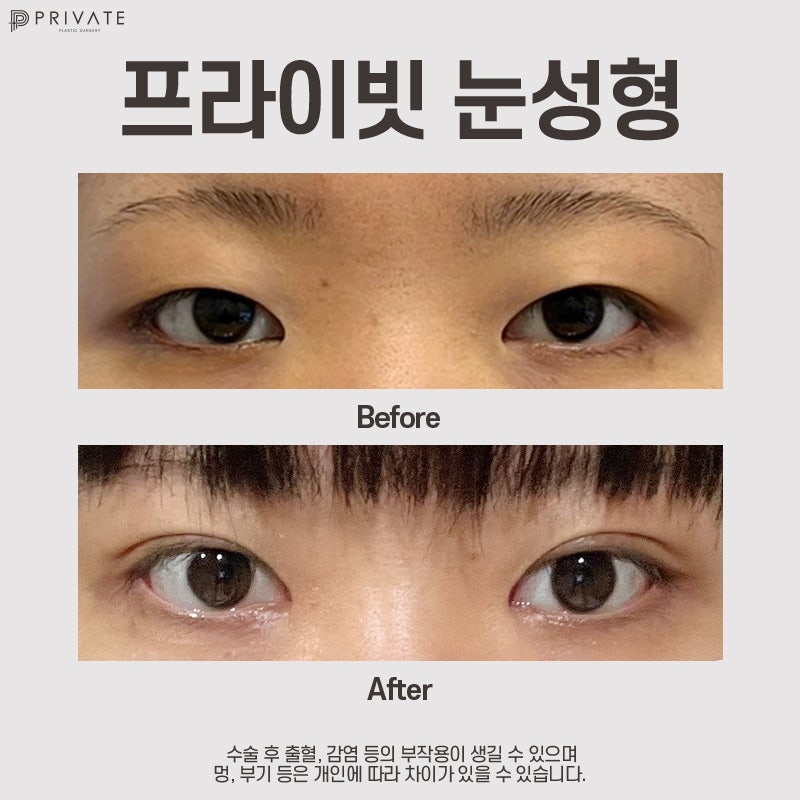 Learn About Incisional Double Eyelid Surgery at Private Plastic Surgery Clinic 사진 9