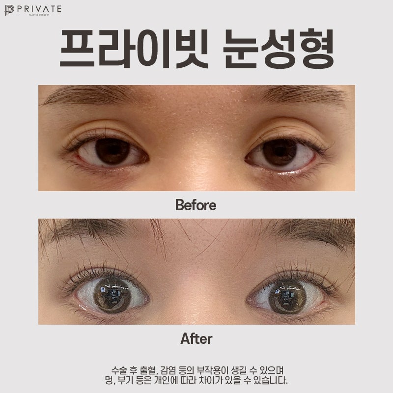 Learn About Incisional Double Eyelid Surgery at Private Plastic Surgery Clinic 사진 8