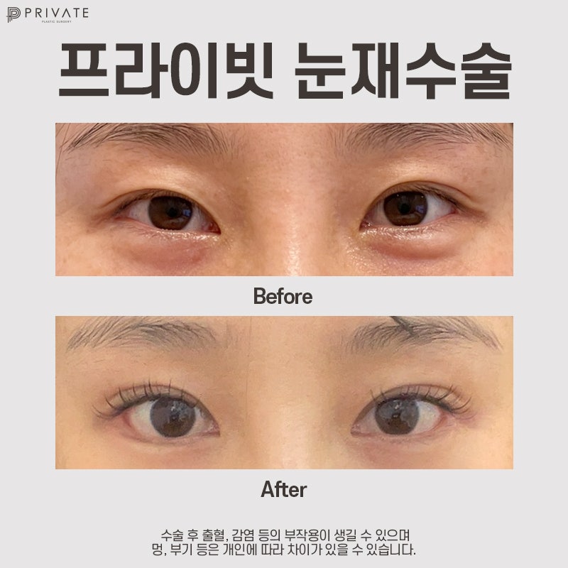 Private Plastic Surgery Clinic ที่มีรีวิวการผ่าตัดแก้ไขตาสองชั้นที่ดี 사진 9