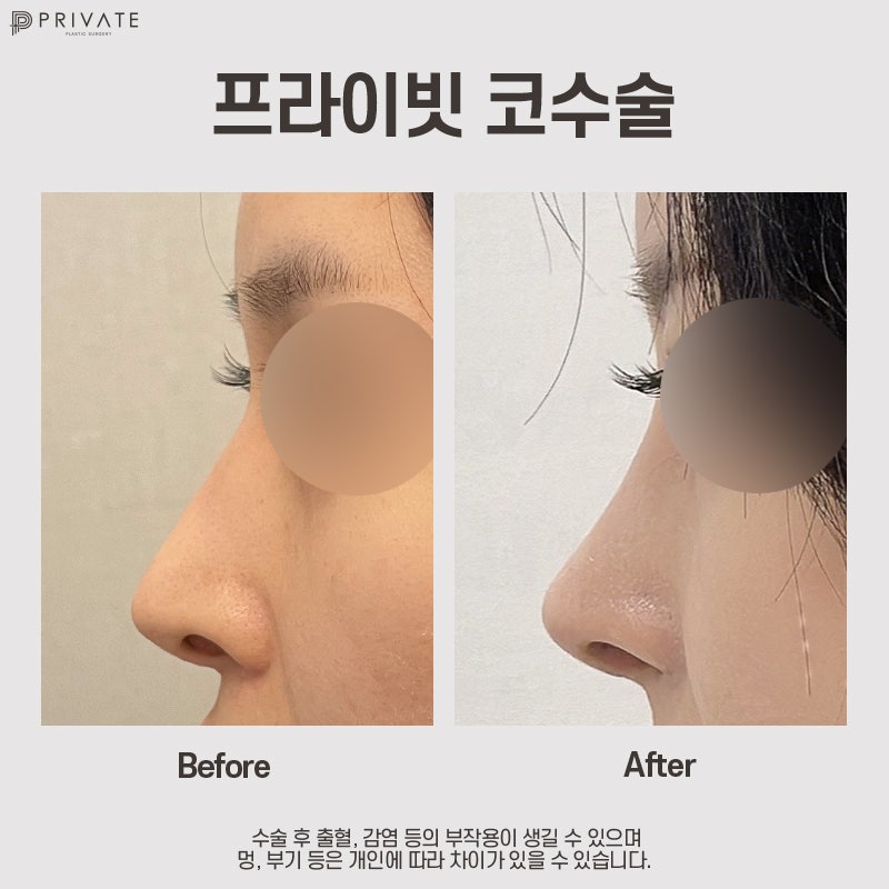 코수술 자가늑, 프라이빗성형외과에서 알아보기 사진 10