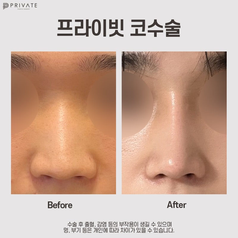 코수술 자가늑, 프라이빗성형외과에서 알아보기 사진 7