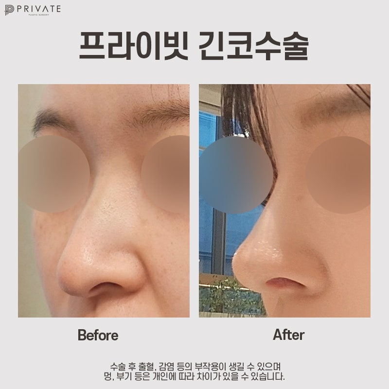 긴코수술잘하는곳은 프라이빗성형외과 사진 9