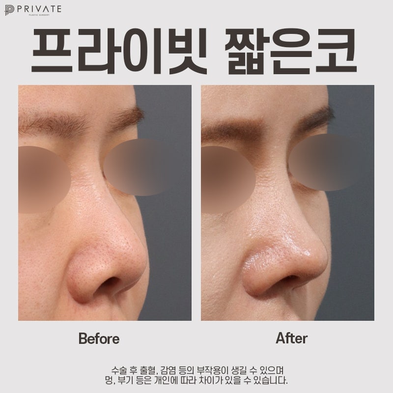 Short Nose Rhinoplasty at Sinsa Private Plastic Surgery 사진 9