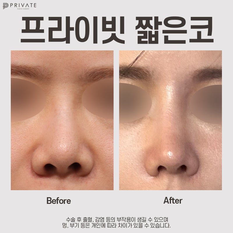 Short Nose Rhinoplasty at Sinsa Private Plastic Surgery 사진 7
