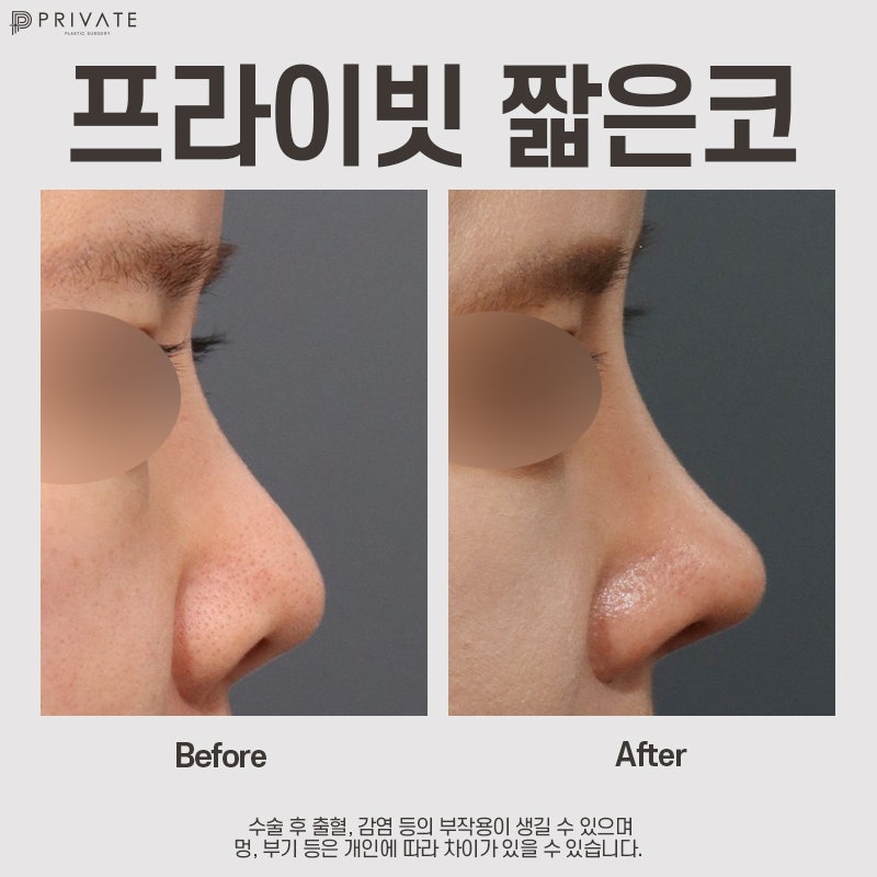 Short Nose Rhinoplasty at Sinsa Private Plastic Surgery 사진 8