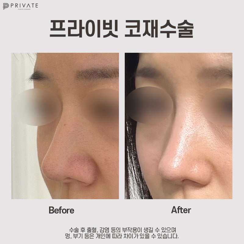 Nose Revision Surgery at Private Plastic Surgery Clinic 사진 8