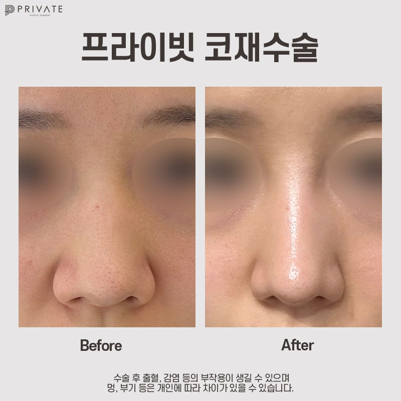 Nose Revision Surgery at Private Plastic Surgery Clinic 사진 7