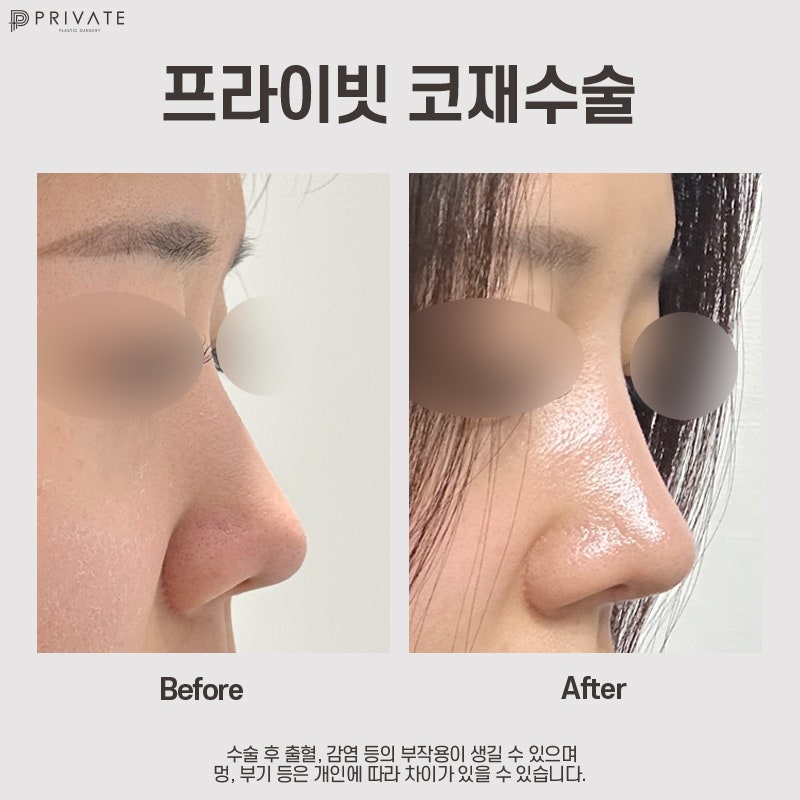 Nose Revision Surgery at Private Plastic Surgery Clinic 사진 9