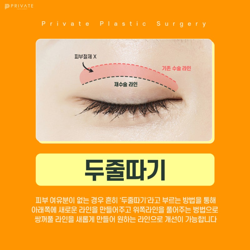 รีวิวศัลยกรรมแก้ไขตาสองชั้นแบบ ‘ไส้กรอก’ ที่ดีเยี่ยมจาก Private Plastic Surgery 사진 4