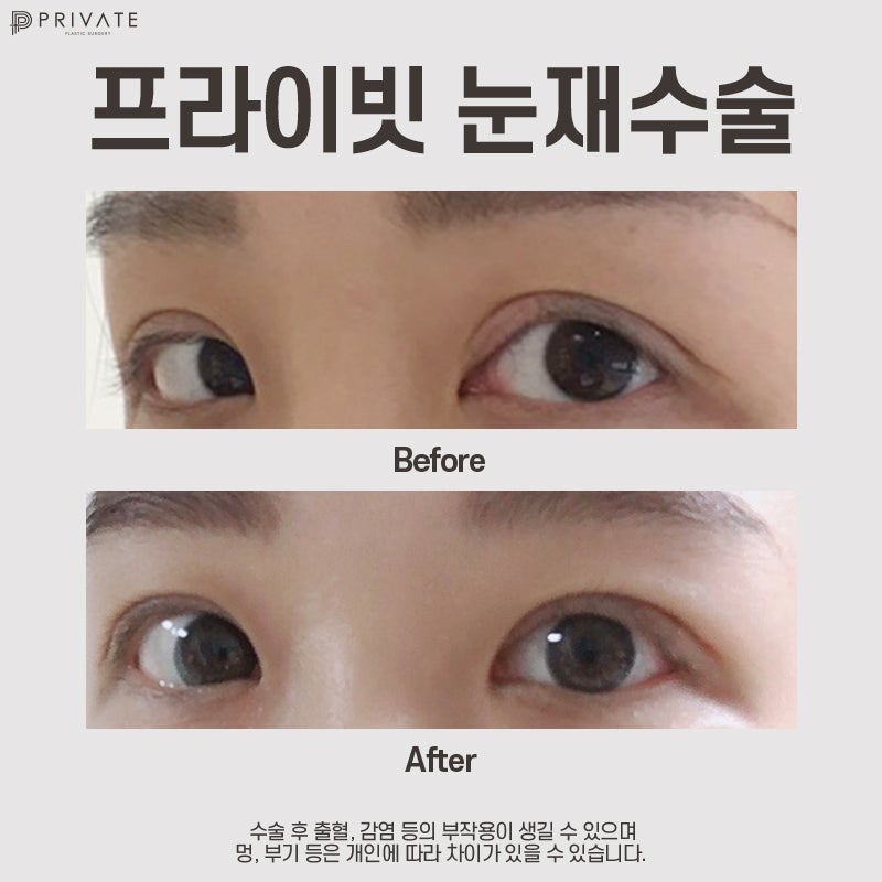 รีวิวศัลยกรรมแก้ไขตาสองชั้นแบบ ‘ไส้กรอก’ ที่ดีเยี่ยมจาก Private Plastic Surgery 사진 10