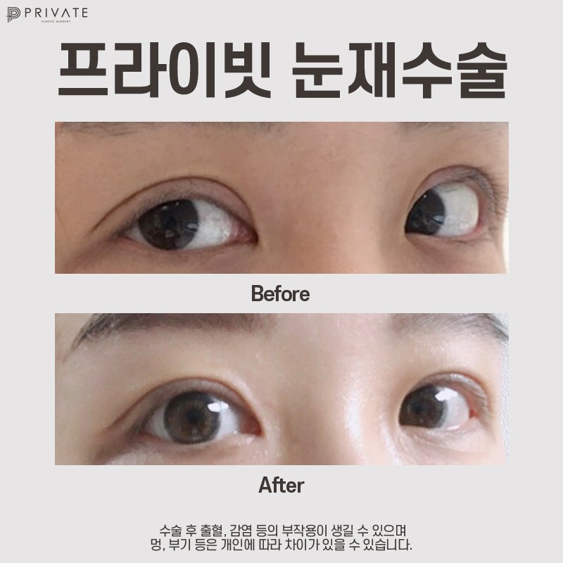 รีวิวศัลยกรรมแก้ไขตาสองชั้นแบบ ‘ไส้กรอก’ ที่ดีเยี่ยมจาก Private Plastic Surgery 사진 9